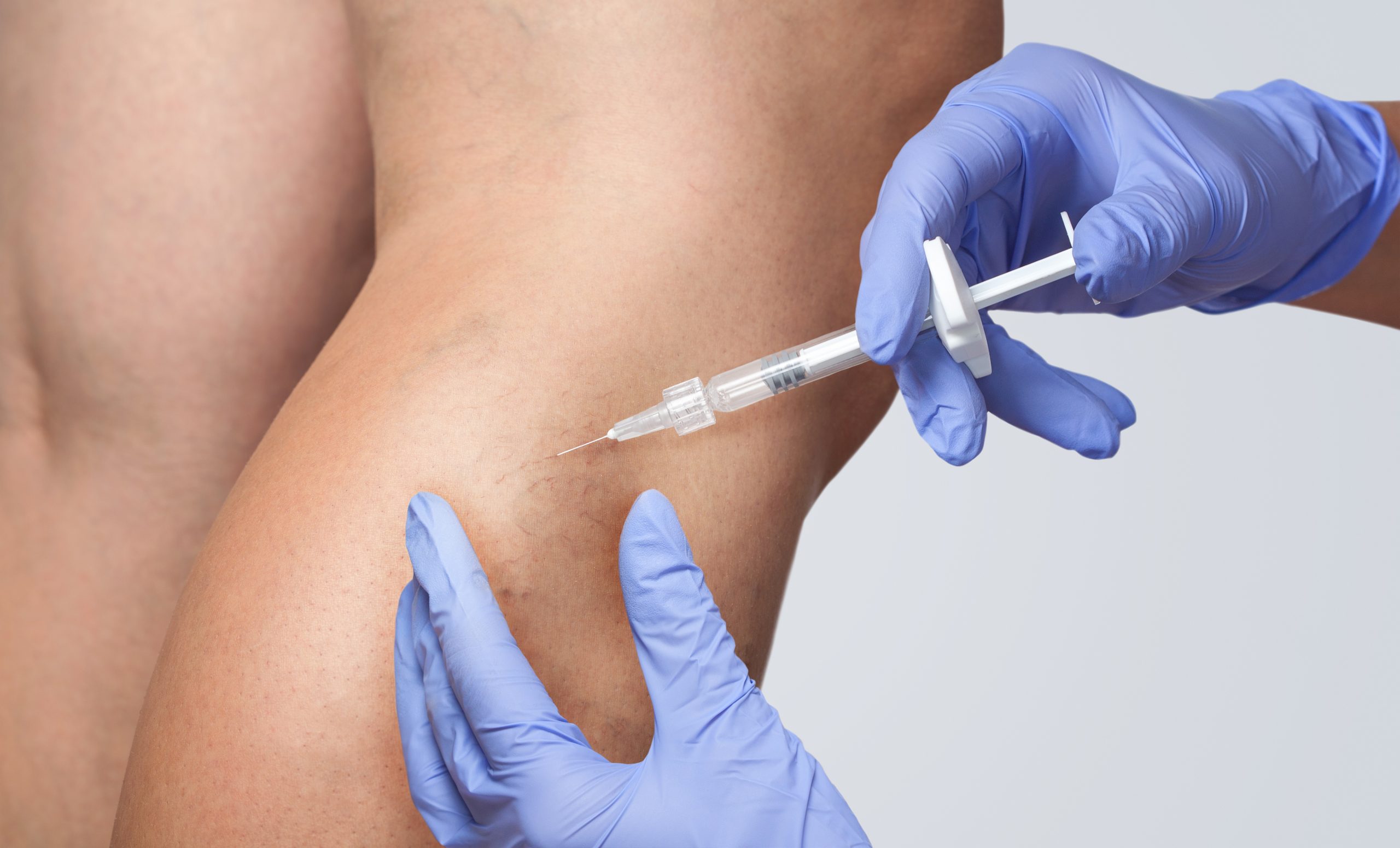 Spider Veins Treatment