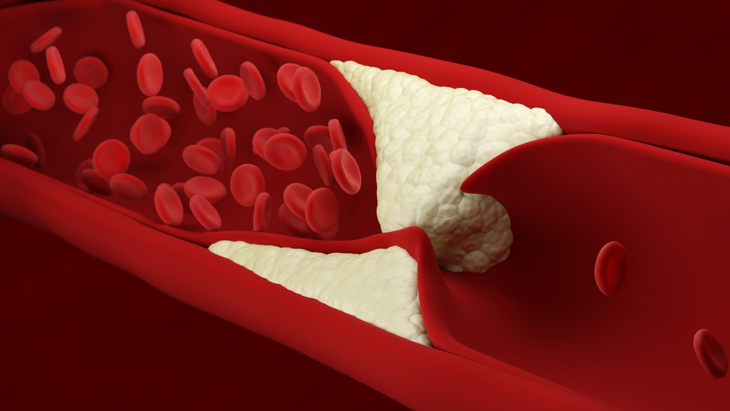 Peripheral Angioplasty