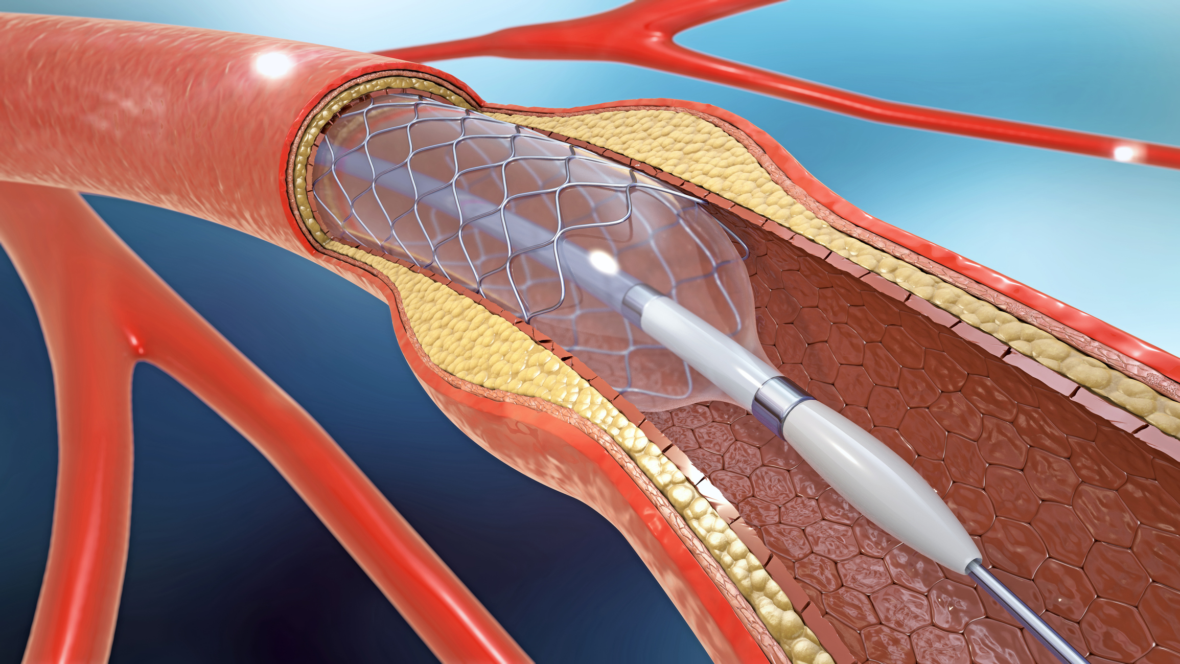 Coronary Balloon Angioplasty