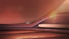 Venaseal Closure