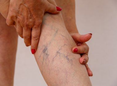 Are Varicose Veins Permanent?