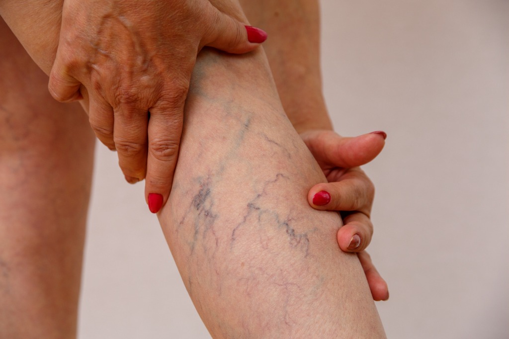 Are Varicose Veins Permanent?