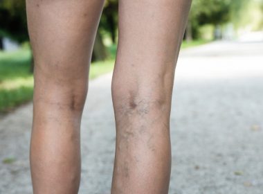 When-do-varicose-veins-become-a-problem