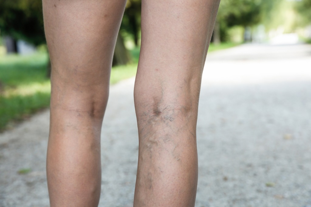 When-do-varicose-veins-become-a-problem